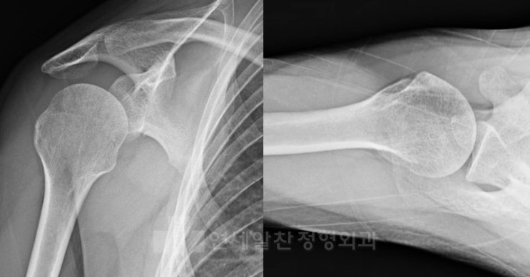 상완골 대결절 골절, 방카르트 병변(전방관절와순파열) 에서 관절경하 방카르트 봉합술