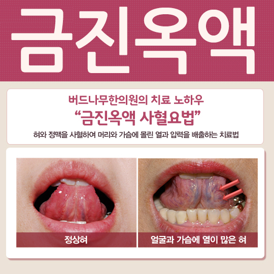 금진옥액 사혈요법, 어혈 제거 한의원 치료는? : 네이버 블로그
