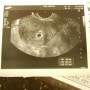 임신8주차 임산부입니다/임신초기증상