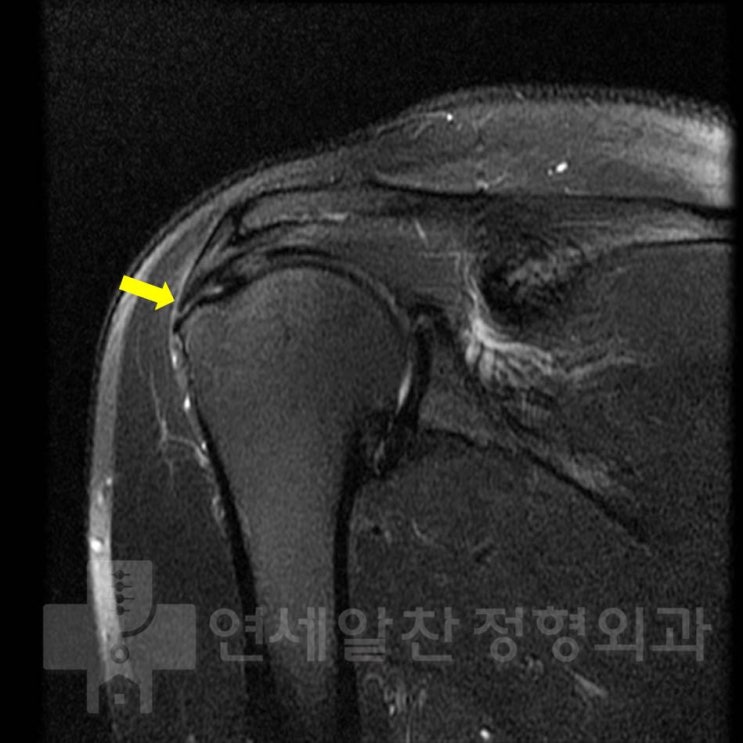 회전근개파열(극상근파열)로 회전근개봉합술(극상근봉합술, 이열교량형봉합법)