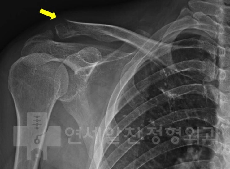 쇄골 원위부 골절에 대한 관혈적 정복술 및 금속내고정술