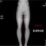 무릎 통증 교정치료