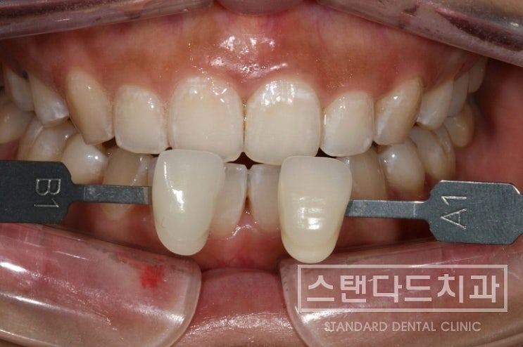 치과 치아미백 / 연예인 치아미백 / 치아미백 후기 / 원 데이 치아미백/ 치아미백 주의사항 : 네이버 블로그