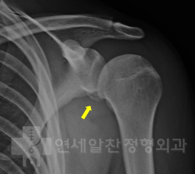 습관성 탈구로 인한 골성 방카르트 병변 및 슬랩 3형에서 방카르트 봉합술 및 이두장건 고정술