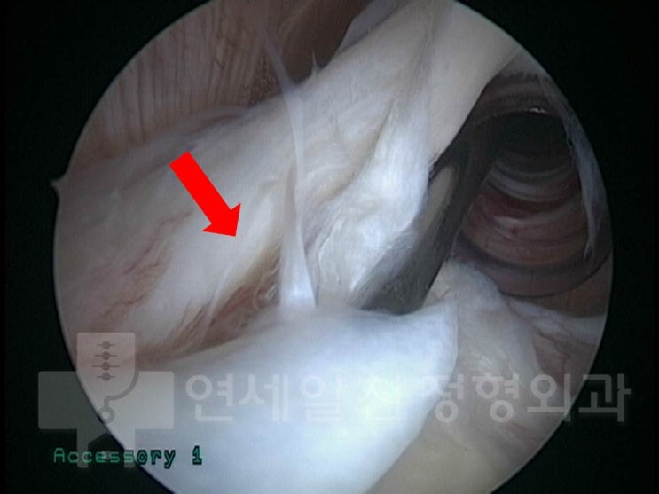 슬랩 4형 (SLAP type IV) 병변에서 이두장건고정술 (biceps tenodesis)