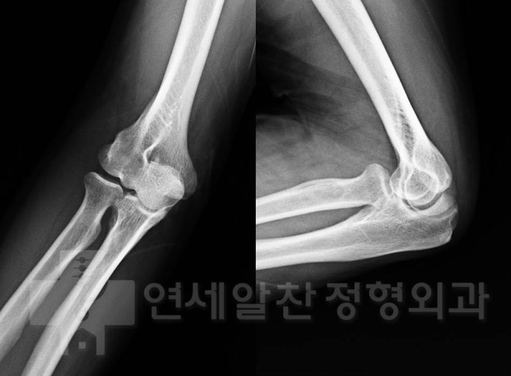 주관절외상과염 ( 테니스엘보우 ) 에서 인대강화주사치료 ( PDRN injection ) 후 초음파 결과