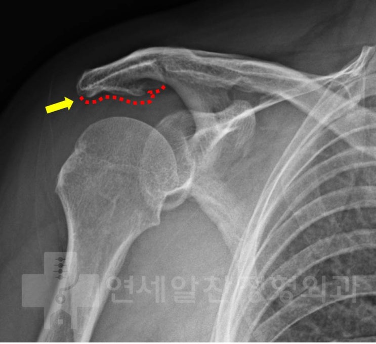 회전근개 광범위 파열에서 하이브리드 봉합술 및 이두장건을 이용한 보강술