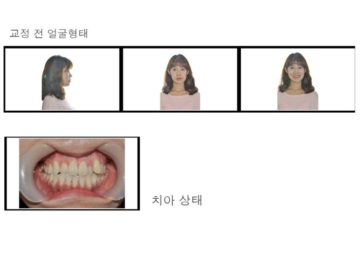 치아교정 쌩리얼후기/30대치아교정후기/안면비대칭교정후기/dyp-photo : 네이버 블로그