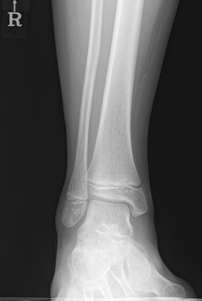 Ankle Mortise : 네이버 블로그