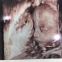 [임신 28주] 임신소양증 극복은 개나줘/아토피/락티케어/페니라민
