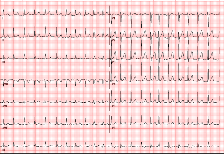 AF, spontaneous cardioversion인 경우에 항응고 전략 : 네이버 블로그