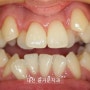 치아교정 후기 전후변화