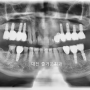 임플란트 초진, 식립후, 최종사진