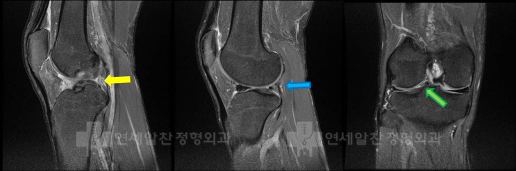 외측 반월상 연골 봉합술의 실패 - 부분 아 절제술