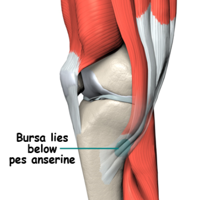 Воспаление коленной мышцы. Тендинит сухожилий гусиной лапки. Анзериновый бурсит коленного сустава. Бурсит гусиной лапки коленного сустава анатомия. Тендинит сухожилия коленного сустава гусиная лапка.