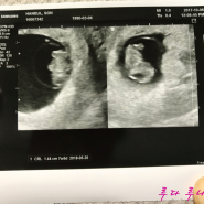 [가을] 임신초기, 8주 1일 3개월 임신초기증상