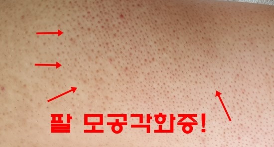 팔 모공각화증 어찌해야할까요?? -대전닭살피부치료 : 네이버 블로그