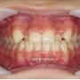 성장기 어린이 치아교정