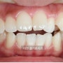 위아랫니가 벌어져 있는 치아교정, 부정교합