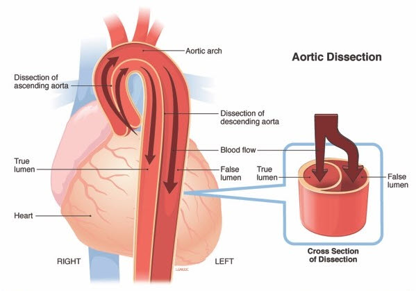 파열 대동맥 대동맥박리