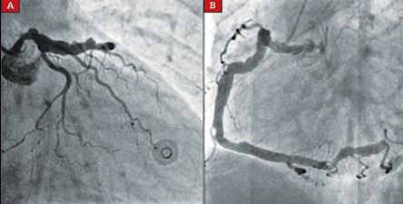 관상 동맥은 너무 늘어 나도 문제가 된다(관상 동맥 확장증; coronary artery ectasia) : 네이버 블로그