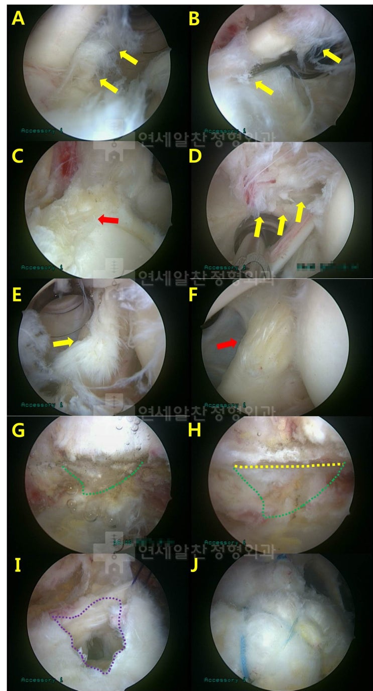 극상근 관절내측 파열에서 수술적 봉합의 결과