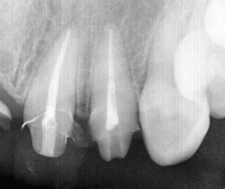 신경치료 근관치료 RCT root canal therapy 앞니신경치료 잠실역치과 바른사람치과 : 네이버 블로그