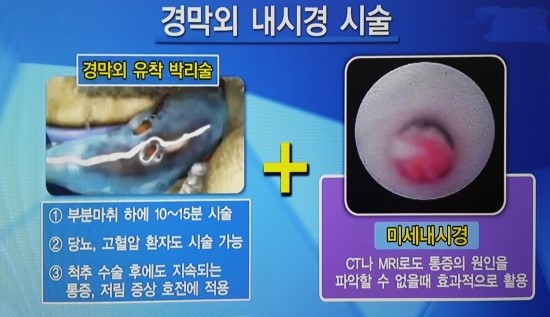 추간판 탈출(디스크) 및 척추협착증 최신 시술 방법 : 네이버 블로그