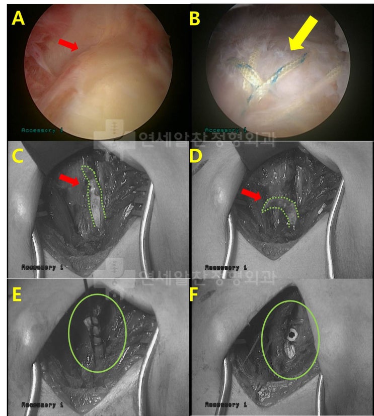 51세 남자 환자에서 이두장건 절제술? 이두장건 고정술.