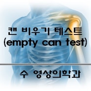 남양주시,구시리 수 영상의학과 입니다."어깨통증, 캔 비우기 검사로 알아봅시다." (극상근 근육)