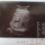 임신 37주 : 태동검사/태아몸무게/막달운동/꼬리뼈 통증