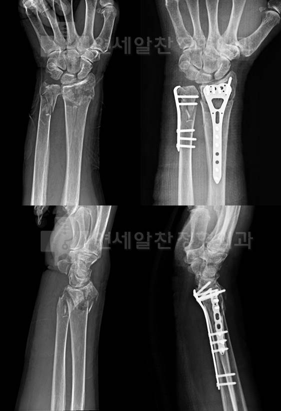원위 요골 및 척골의 복잡 골절에 대한 관혈적 정복술 및 금속 내고정술의 결과
