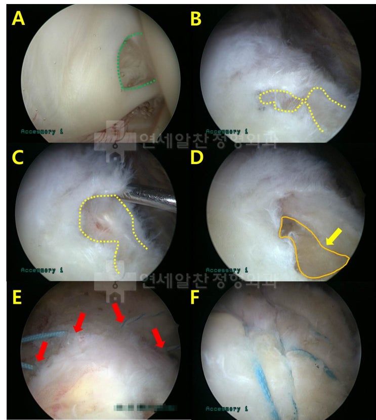 극상근 파열에 대한 치료에 대한 고찰