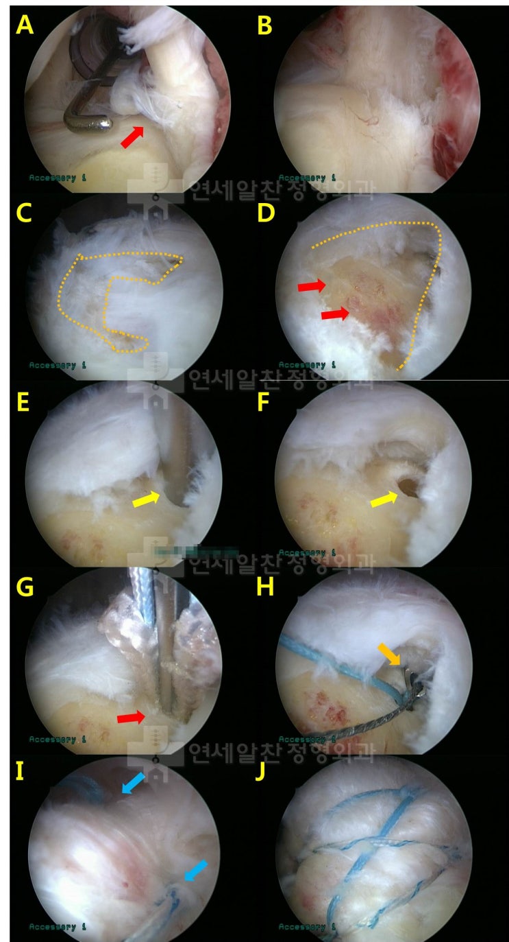 이중교량형 봉합술의 장점