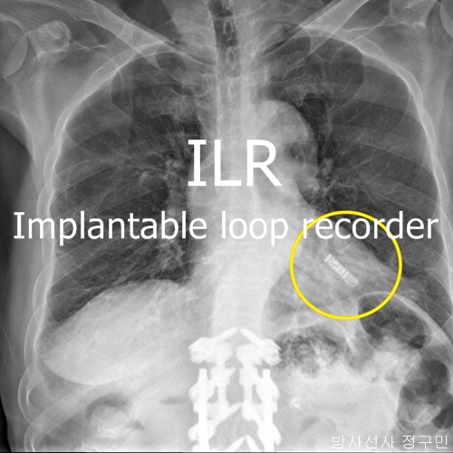 Implantable loop recorder (ILR) : 네이버 블로그