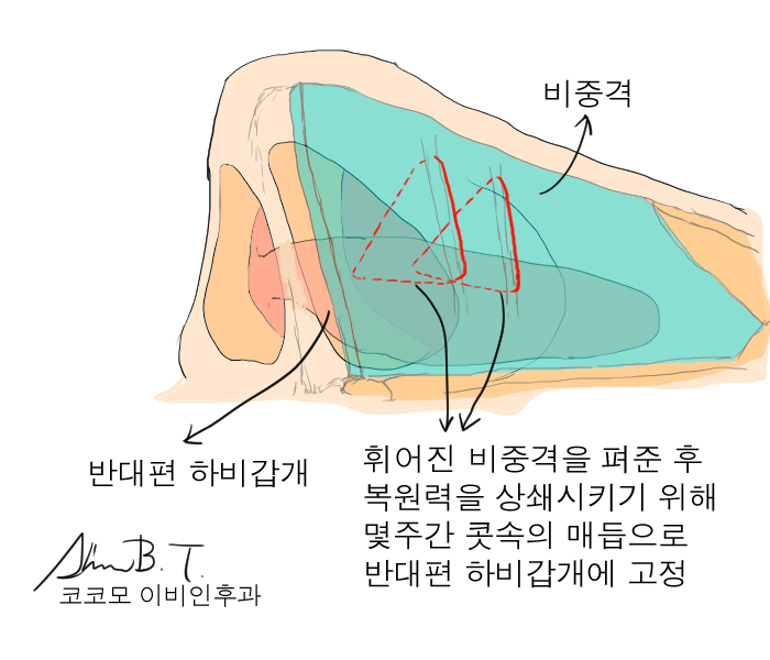 비중격만곡증 수술후 지혈솜과 그 제거시 통증이 걱정되시나요? : 네이버 블로그