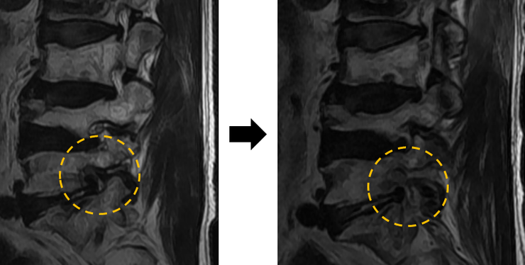 추간공 접근법 - Paraspinal approach L5/S1, Lt : 네이버 블로그