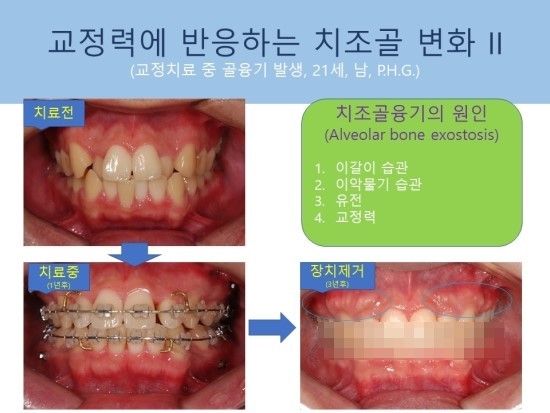 교정치료와 관련된 치조골융기 alveolar bone exostosis - ﻿ 웃는E치과교정과 : 네이버 블로그