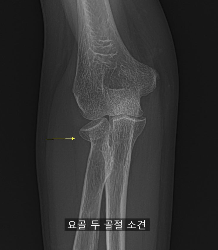 열흘 지난 요골 골두 골절의 수술적 치료 : 네이버 블로그