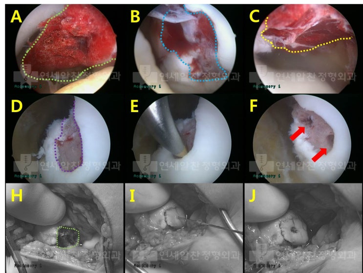슬개골 탈구 및 슬개연골 손상에서 관절경적 치료 및 슬개연골 고정술의 결과
