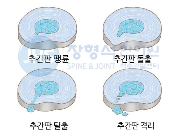 추간판 돌출에 대해 알아보자! : 네이버 블로그