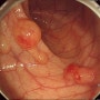 창자벽공기낭증(pneumatosis coli)