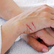 피부가 찢어지는 상처인 열상과 상처가 생겼을때 대처하는 방법과 치료법에 대하여 알아보겠습니다.