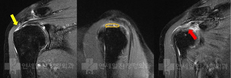 고령의 극상근 파열에서 이중교량형 봉합법을 이용한 수술의 결과
