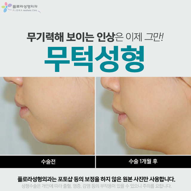 무턱성형 이래서 해야되요 : 네이버 블로그