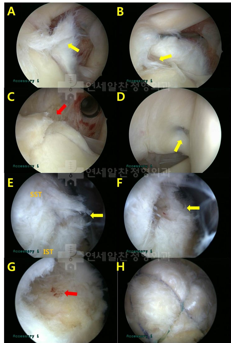 극상근 점액낭측 파열에서 이중교량형 봉합법을 이용한 수술의 결과