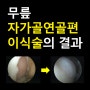 무릎 자가골연골편 이식술의 결과 / 청주 마디사랑병원