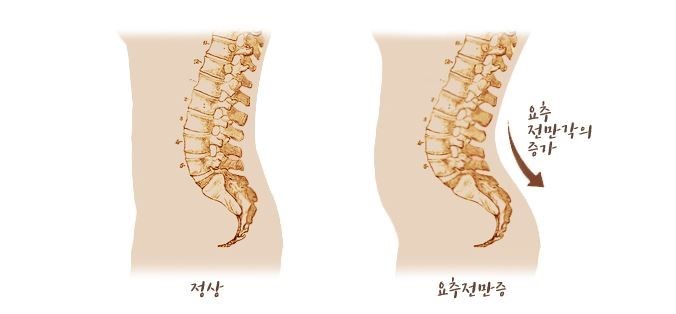 요추 전만 자세와 자연 복대를 자연스럽게 하는 방법 : 네이버 블로그