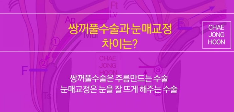 쌍꺼풀수술과 눈매교정(안검하수교정)의 차이는? 절개법, 부분절개법, 비절개법(매몰법)의 차이는? : 네이버 블로그