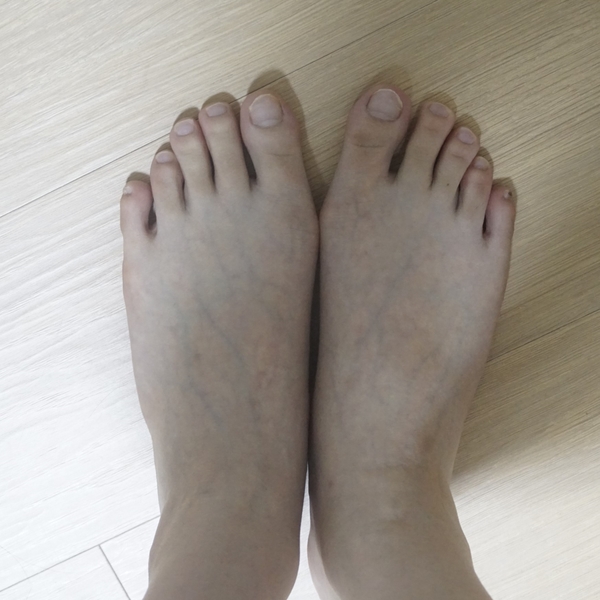 무지외반증교정기 3개월 사용한 후기 : 네이버 블로그